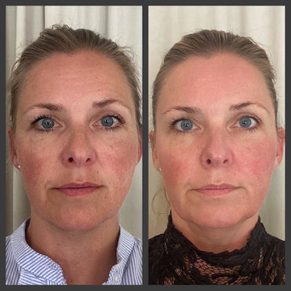 Før og efter billede af Trine, efter 6 Pro Peel behandlinger