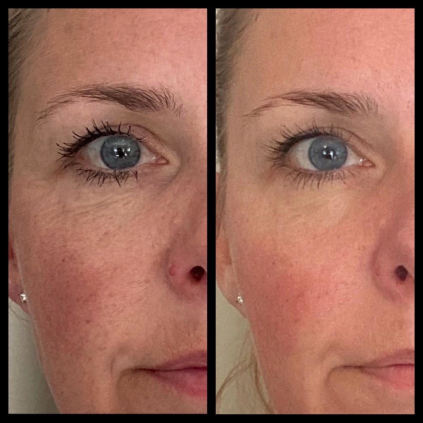 Før og efter billede af Trines øjenomgivelser, efter 6 Pro Peel behandlinger