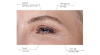  Fillerina® 12HA Specific Zones Eyes & Eyelids – Grad 5 plus, filler uden injektion